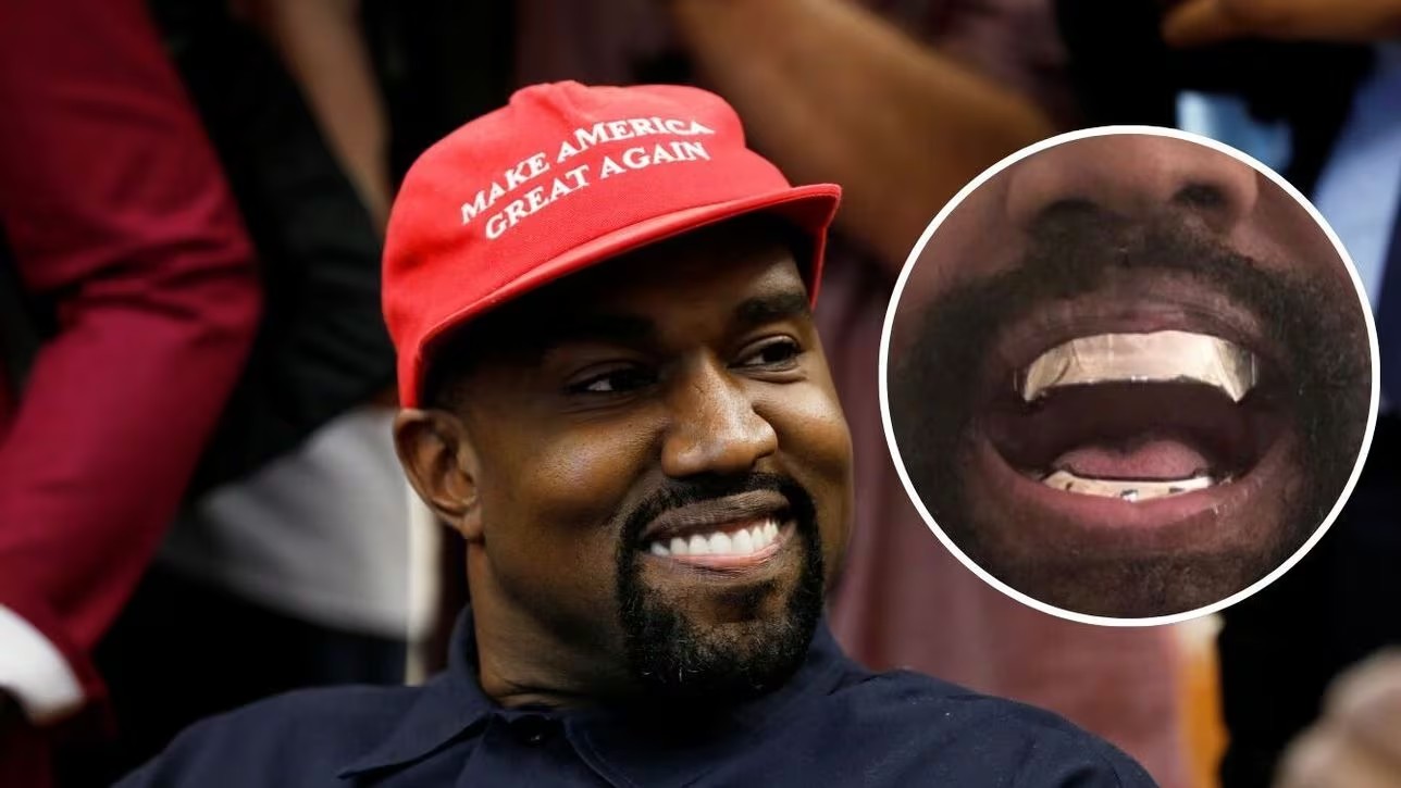 <strong>Kanye West replaces his teeth with $850K Titanium dentures</strong>